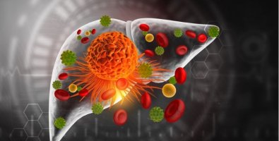Can Advanced Liver Cancer Become Operable- Downstaging Treatments Explained Can Advanced Liver Cancer Become Operable- Downstaging Treatments Explained