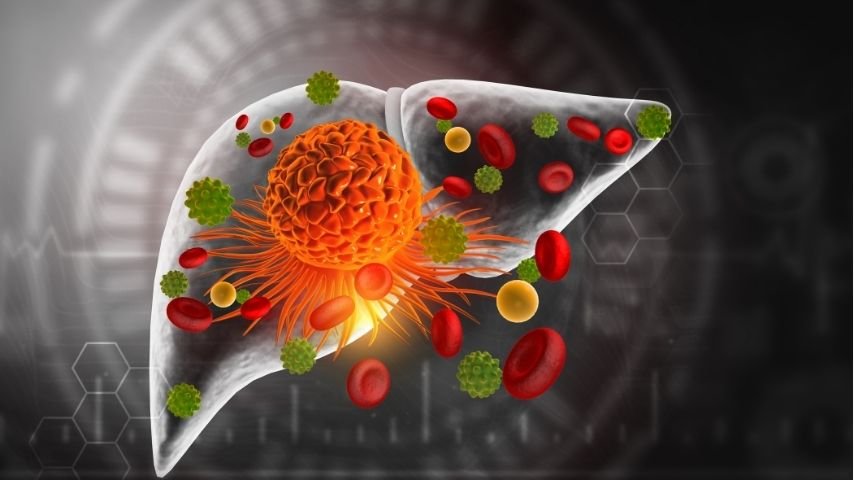 Can Advanced Liver Cancer Become Operable- Downstaging Treatments Explained Can Advanced Liver Cancer Become Operable- Downstaging Treatments Explained