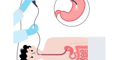PEG Tube Placement-When Is It Needed and How Is It Done PEG Tube Placement-When Is It Needed and How Is It Done