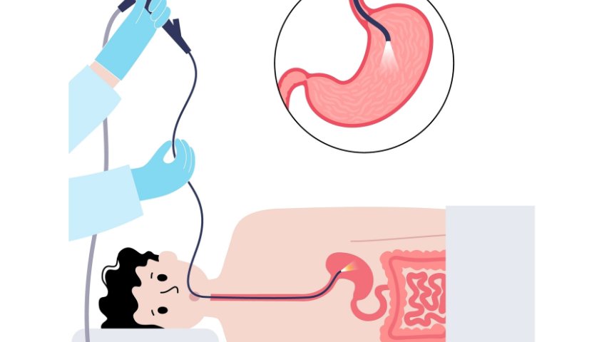 PEG Tube Placement-When Is It Needed and How Is It Done PEG Tube Placement-When Is It Needed and How Is It Done