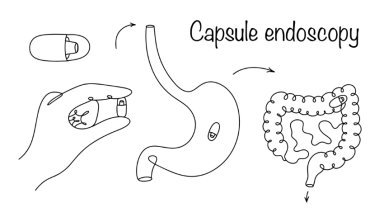What Happens After a Capsule Endoscopy- Understanding Results, Findings, and Next Steps What Happens After a Capsule Endoscopy- Understanding Results, Findings, and Next Steps