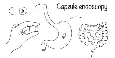 What Happens After a Capsule Endoscopy- Understanding Results, Findings, and Next Steps What Happens After a Capsule Endoscopy- Understanding Results, Findings, and Next Steps