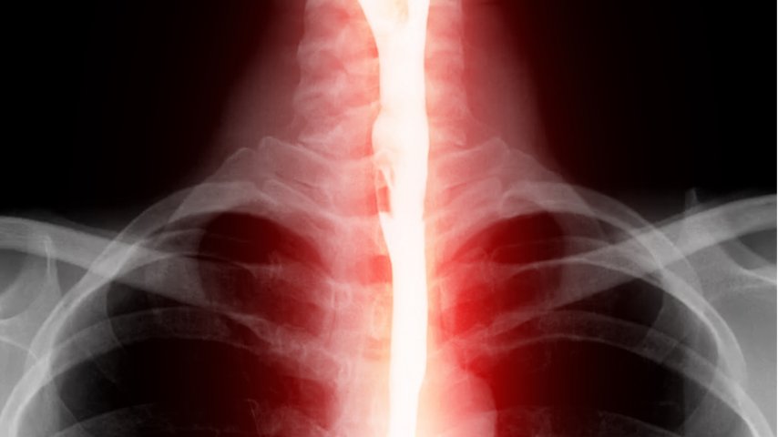 Barium Swallow Test-When Your Doctor Recommends It and Why