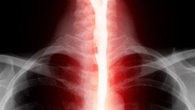 Barium Swallow Test-When Your Doctor Recommends It and Why Barium Swallow Test-When Your Doctor Recommends It and Why