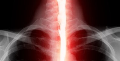 Barium Swallow Test-When Your Doctor Recommends It and Why Barium Swallow Test-When Your Doctor Recommends It and Why