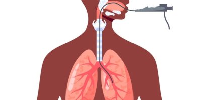 Why Tumors, Scar Tissue, or Infections Can Narrow the Windpipe Why Tumors, Scar Tissue, or Infections Can Narrow the Windpipe