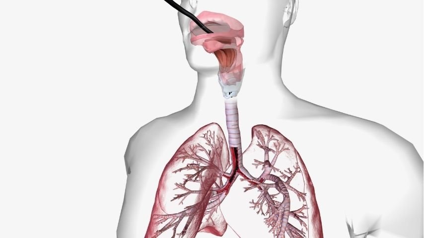 Bronchoscopic Tracheal Stent Placement Explained- How Doctors Open a Blocked Airway