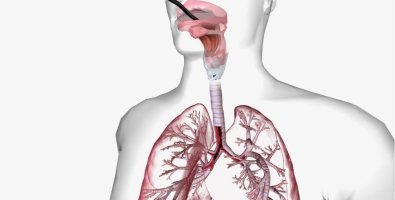 Bronchoscopic Tracheal Stent Placement Explained- How Doctors Open a Blocked Airway Bronchoscopic Tracheal Stent Placement Explained- How Doctors Open a Blocked Airway