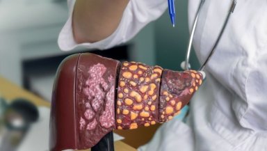 What Does “Inoperable Liver Cancer” Really Mean What Does “Inoperable Liver Cancer” Really Mean