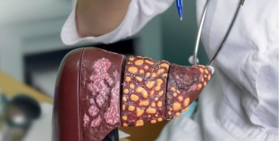 What Does “Inoperable Liver Cancer” Really Mean What Does “Inoperable Liver Cancer” Really Mean