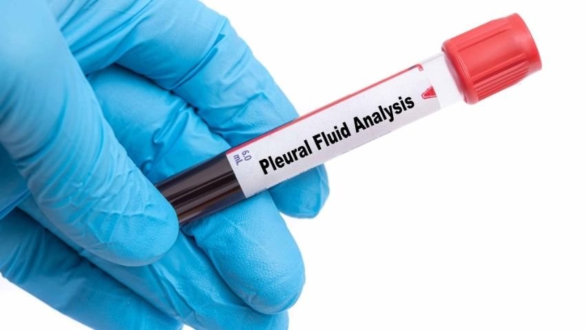 Pleural Fluid- What Causes It, Symptoms to Watch For, and When to See a Doctor