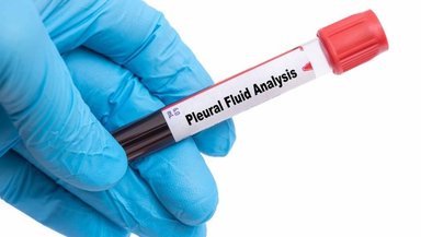 Pleural Fluid- What Causes It, Symptoms to Watch For, and When to See a Doctor Pleural Fluid- What Causes It, Symptoms to Watch For, and When to See a Doctor