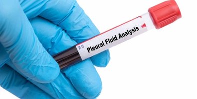 Pleural Fluid- What Causes It, Symptoms to Watch For, and When to See a Doctor Pleural Fluid- What Causes It, Symptoms to Watch For, and When to See a Doctor