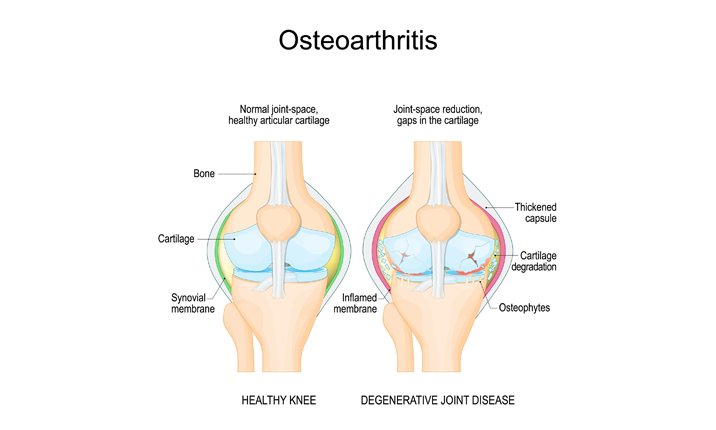 A comparison between a healthy knee and a knee suffering from osteoarthritis. healthy-vs-osteoarthritis-knee-comparison