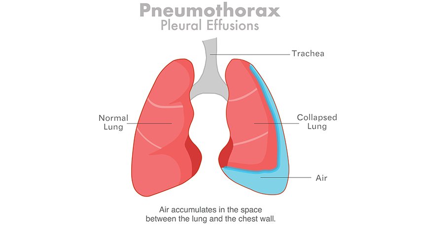 Loculated Pleural Effusion and Adhesions-Can Thoracoscopy Really Help