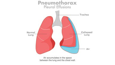 Loculated Pleural Effusion and Adhesions-Can Thoracoscopy Really Help Loculated Pleural Effusion and Adhesions-Can Thoracoscopy Really Help