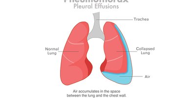 Loculated Pleural Effusion and Adhesions-Can Thoracoscopy Really Help Loculated Pleural Effusion and Adhesions-Can Thoracoscopy Really Help