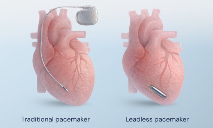 Pacemaker therapy