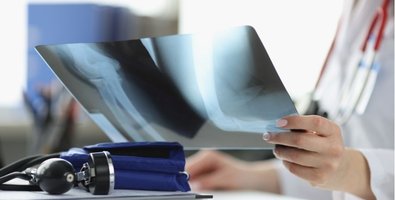 Cost of Revision Hip and Knee Replacement- What Patients and Families Should Expect Cost of Revision Hip and Knee Replacement- What Patients and Families Should Expect