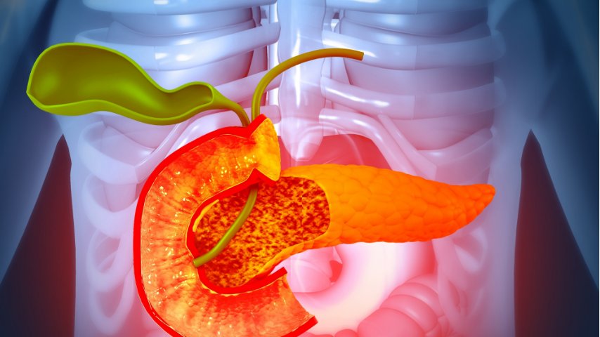 Laparoscopic vs Open Distal Pancreatectomy- Which Recovery Is Better