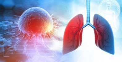 Lung Nodule Found on CT Scan- Why Doctors May Recommend an EBUS Test Lung Nodule Found on CT Scan- Why Doctors May Recommend an EBUS Test