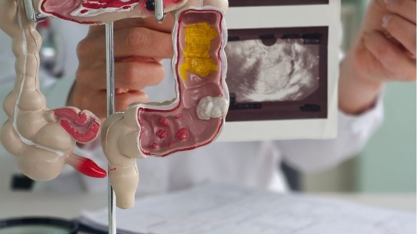 Colorectal Surgery Recovery-What Is Normal in the First 6 Weeks and What Should Worry You