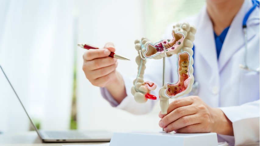 Early Detection of Colon Cancer Through Preventive GI Procedures Early Detection of Colon Cancer Through Preventive GI Procedures