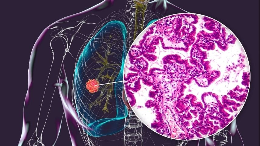 Peripheral Lung Nodules Explained-Why Doctors Use CT Imaging to Guide a Biopsy