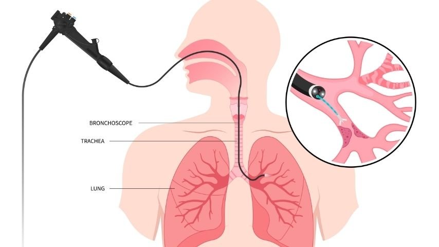 What Is Endobronchial Ultrasound (EBUS)- A Simple Guide for Patients With Lung Nodules or Suspected Lung Cancer What Is Endobronchial Ultrasound (EBUS)- A Simple Guide for Patients With Lung Nodules or Suspected Lung Cancer