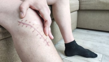 Managing Pain and Mobility After Free Flap Surgery — A Simple Patient Guide Managing Pain and Mobility After Free Flap Surgery — A Simple Patient Guide