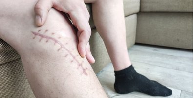 Managing Pain and Mobility After Free Flap Surgery — A Simple Patient Guide Managing Pain and Mobility After Free Flap Surgery — A Simple Patient Guide