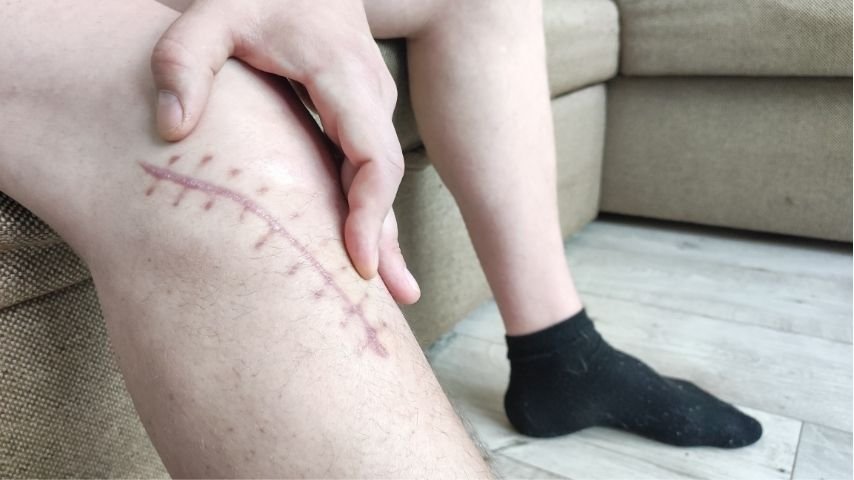 Managing Pain and Mobility After Free Flap Surgery — A Simple Patient Guide Managing Pain and Mobility After Free Flap Surgery — A Simple Patient Guide