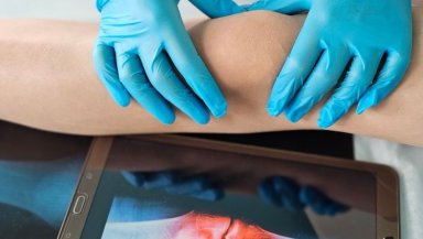 Is Genicular Artery Embolization Safe- Risks, Side Effects, and Success Rates Is Genicular Artery Embolization Safe- Risks, Side Effects, and Success Rates