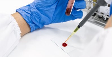 10 Powerful Blood Thinning Foods- Natural Ways to Reduce Blood Thickness Safely 10 Powerful Blood Thinning Foods- Natural Ways to Reduce Blood Thickness Safely