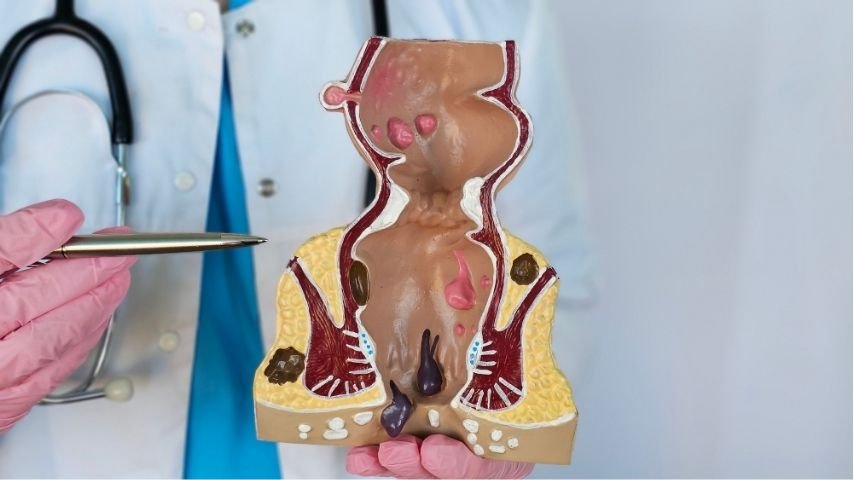 Grade 1, 2, 3 or 4 Piles- What Does Your Hemorrhoid Grade Actually Mean for Treatment