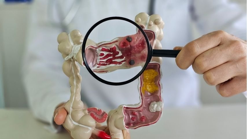 Colorectal Surgery Recovery Isn't Going as Expected- When Persistent Pain, Bowel Problems or Fatigue Need a Doctor's Review