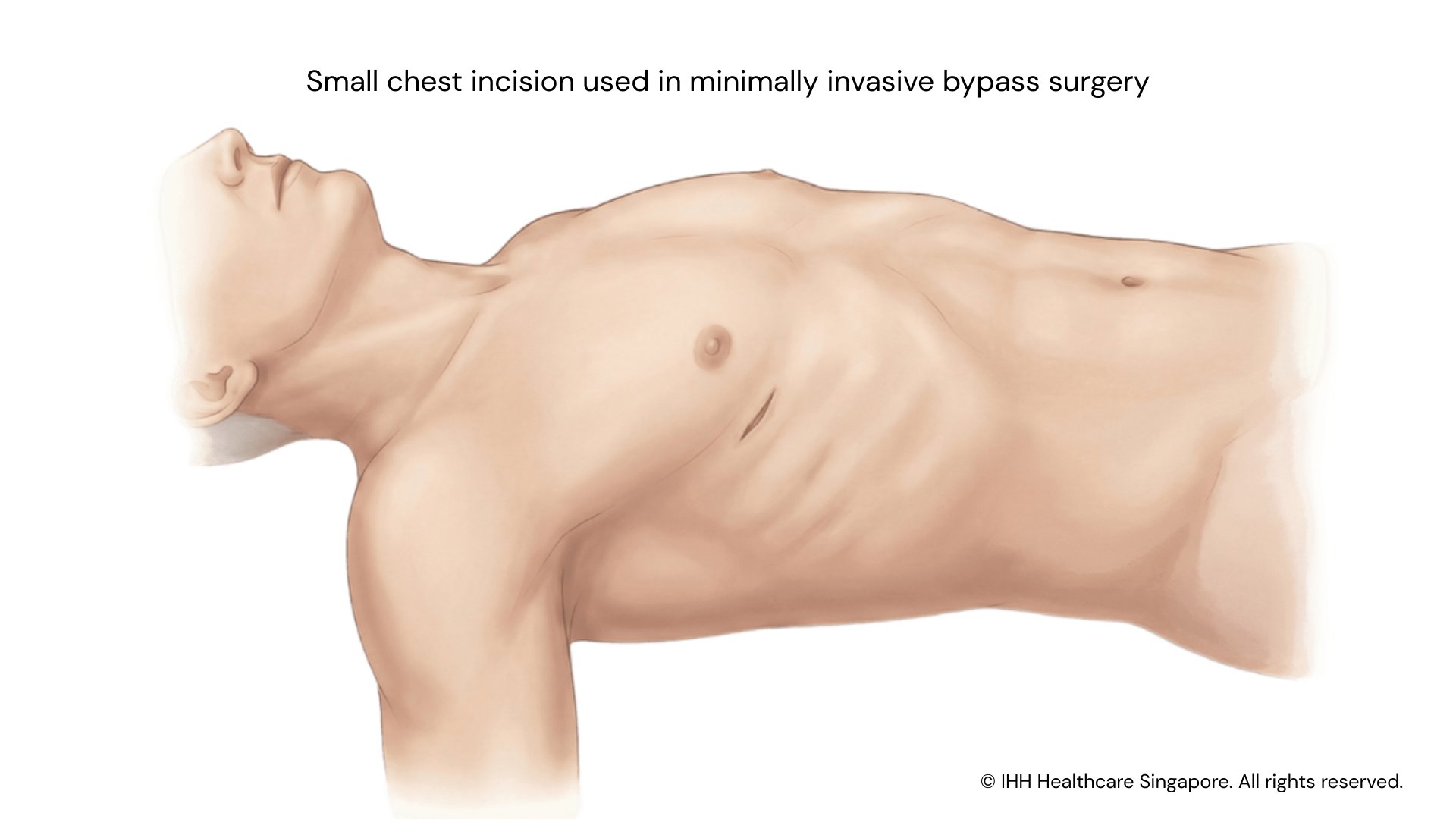 Small chest incision used in MICS 1920x1080