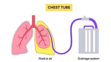 How Medical Thoracoscopy Helps With Repeated Chest Fluid and Trapped Lung How Medical Thoracoscopy Helps With Repeated Chest Fluid and Trapped Lung