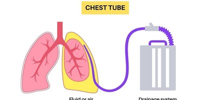 How Medical Thoracoscopy Helps With Repeated Chest Fluid and Trapped Lung How Medical Thoracoscopy Helps With Repeated Chest Fluid and Trapped Lung