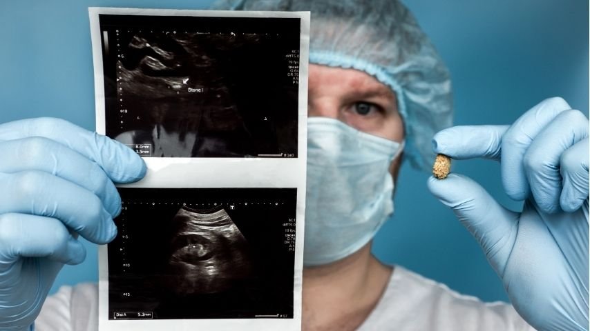 ECIRS Explained Simply-A Patient-Friendly Guide to Endoscopic Combined Intrarenal Surgery ECIRS Explained Simply-A Patient-Friendly Guide to Endoscopic Combined Intrarenal Surgery