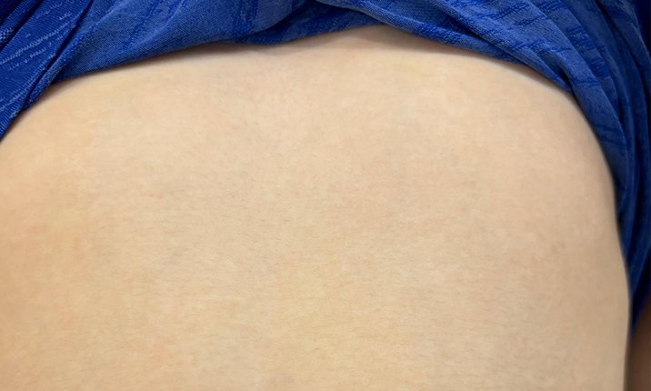 Recovered skin - in text image