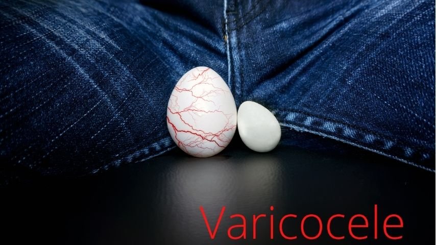 What Does Varicocele Embolization Feel Like-Real Patient Experience Explained
