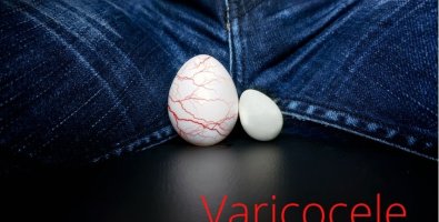 What Does Varicocele Embolization Feel Like-Real Patient Experience Explained What Does Varicocele Embolization Feel Like-Real Patient Experience Explained