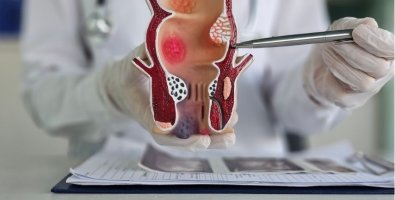 Can an Anal Fistula Heal on Its Own- What Happens If You Keep Waiting Can an Anal Fistula Heal on Its Own- What Happens If You Keep Waiting