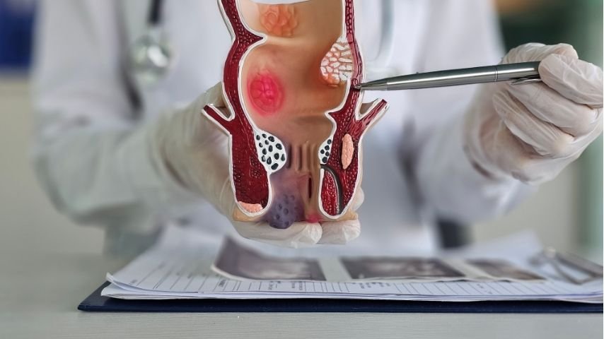 Can an Anal Fistula Heal on Its Own- What Happens If You Keep Waiting Can an Anal Fistula Heal on Its Own- What Happens If You Keep Waiting