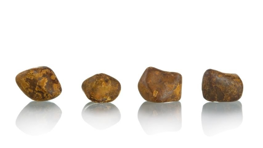 Gallstones 101- Causes, Symptoms, and How They Lead to Cholecystectomy