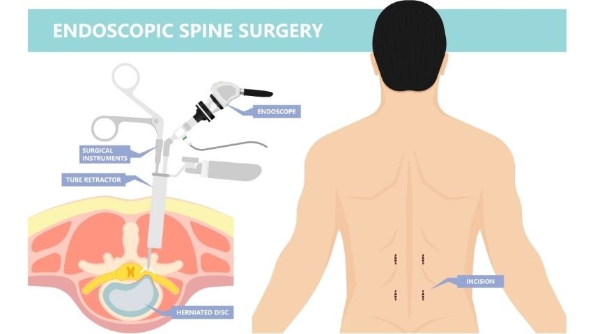 What Is Endoscopic Spine Surgery- A Simple Guide for Patients With Sciatica and Disc Problems