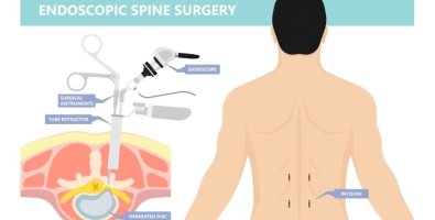 What Is Endoscopic Spine Surgery- A Simple Guide for Patients With Sciatica and Disc Problems What Is Endoscopic Spine Surgery- A Simple Guide for Patients With Sciatica and Disc Problems