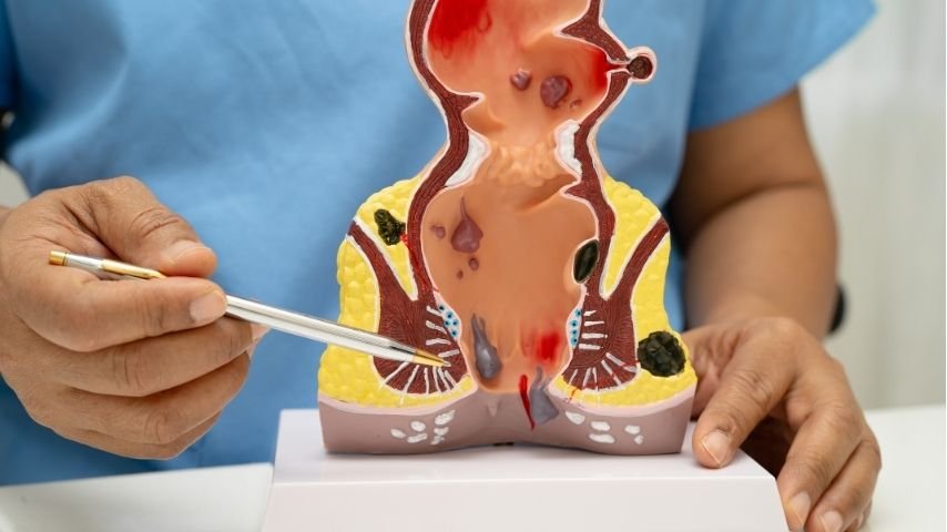 Can Piles Heal Without Surgery- What Happens If You Keep Delaying Hemorrhoid Treatment