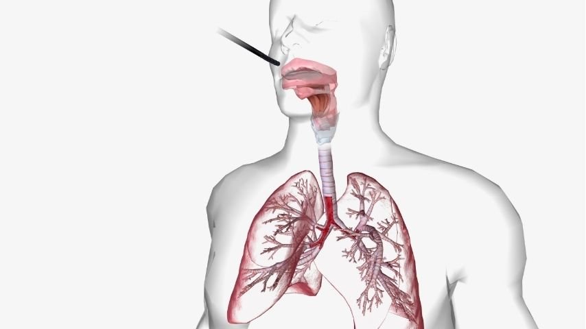 Navigation Bronchoscopy vs CT-Guided Lung Biopsy-Which Test Is Better for Lung Nodules